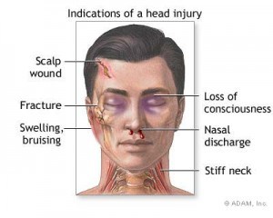 concussion can lead to brain injury