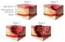 Diagram of bed sores at four stages